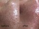 サロン フィオーレ(salon fiore)の写真/黒ずみ毛穴気になる?美容液を使用する贅沢な毛穴洗浄なら当店へ!丁寧なクレンジング洗浄で満足の素肌♪