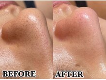 ノイ(Noi)/【毛穴】本気の肌質改善