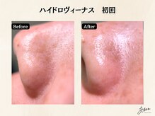 あすはれ/当サロンのハイドロヴィーナス