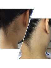 カルム(Calme)/うなじ脱毛