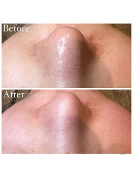 マドモアゼル 麻布十番/毛穴洗浄