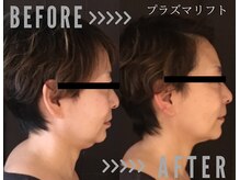 小顔ウナ学芸大学店(UNA)の雰囲気（クーポン「プラズマリフト×脂肪燃焼・分解液導入」コース１回）