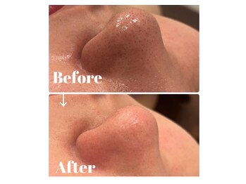 カラーリリー アンド ユン(Calla lily & yun)/毛穴洗浄で黒ずみスッキリ！！