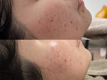 ピブ(PIBU)/ニキビ症例/ハーブピーリング