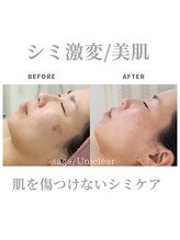 ユニクリア(Uni clear)/シミケア・ハーブピーリング&IPL