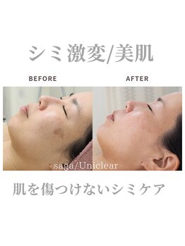 ユニクリア(Uni clear)/シミケア・ハーブピーリング&IPL