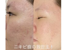 ビューティー アディクト(Beauty addict)/肌質改善フェイシャル