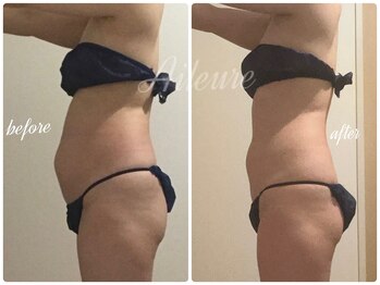 エルール トータルビューティ(Aileure total beauty)/インディバx燃焼ジェルxアミノ酸