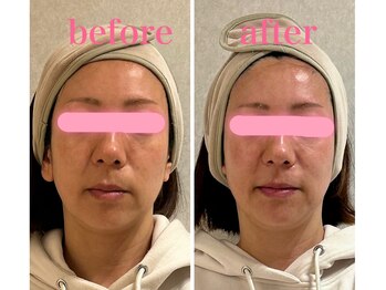 リセス(Recess)/1回でも艶、ハリ、小顔に!