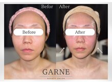 ガーネ 堺店(GARNE)/小顔・リフトアップ１回/30代