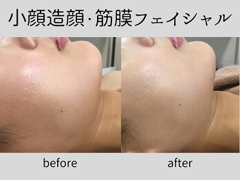 マーベル(MaaBelle)/20代/小顔造顔・筋膜リリース