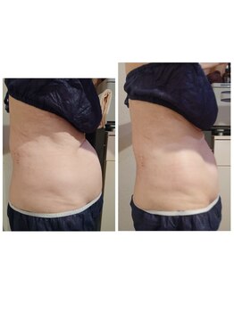 ルクソール/レモンボトル(痩身)