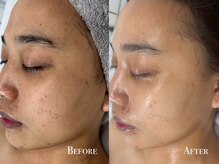 イースト(EAST)/プラズマシャワー4回