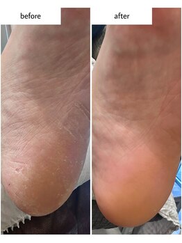 ケアプラス(care plus)/足裏角質ケア