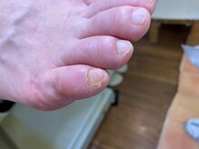 フットメンテ 巻き爪矯正センター 南浦和/副爪　施術前