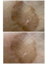 ラティメリア(Latimeria)/本気の肌質改善ハーブピーリング