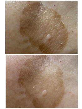 ラティメリア(Latimeria)/本気の肌質改善ハーブピーリング