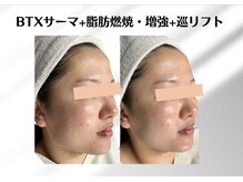 アールメディカルサロン 富山院(R Medical Salon)/サーマクール小顔