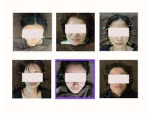 ハリキュウナチュラ(harikyuナチュラ)/人気の美容鍼です。男性にも