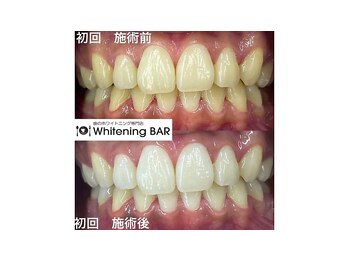 ホワイトニングバー 心斎橋オーパ店/初回の変化｜ビフォーアフター