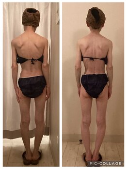 小顔コルギ専門店 フェルーシュ 成田駅前店(Feruche)/背中+小顔コルギ 結果写真