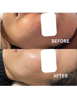 ブルーム(BLOOM)/LAHピーリング×IPL