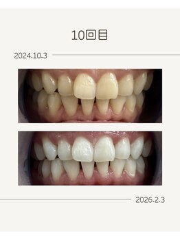 ホワイトニングショップ 福岡姪浜店/お客様before after