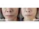 サンティエ(Santie)の写真/たるみ引き上げ3種類マシーン使用であの頃の若々しいフェイスラインへ!