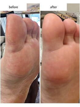 ケアプラス(care plus)/足裏角質ケア