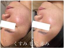 エル(Elle)/赤み 毛穴 くすみ