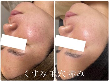 エル(Elle)/赤み 毛穴 くすみ