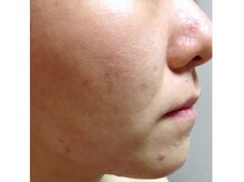 スキンケアスタジオ アコ 新宿店(Aco)/GP肌活２Dのお客様7日後