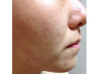 スキンケアスタジオ アコ 新宿店(Aco)/GP肌活２Dのお客様7日後