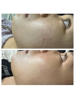 ルビー 新宿(Ruby)/ハーブピーリング5回の施術