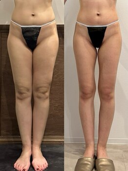 パリスヒロトン(PARIS HIROTON)/6ヶ月 痩身症例写真(30代)