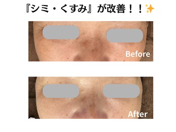 グレースティー 森町 箕面/『シミ・くすみ』変わる！！