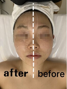 ナラビューティー(NARA BEAUTY)/輪郭リフト+小顔コルギ恵比寿