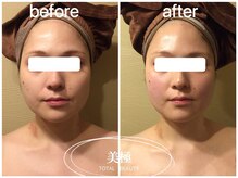 美極 銀座店/銀座/小顔コルギ/小顔矯正