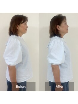 チャーミーアシスト(charmy assist)/小顔リフト整顔