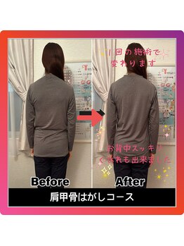 メディカル整体院/肩甲骨はがし★ビフォーアフター