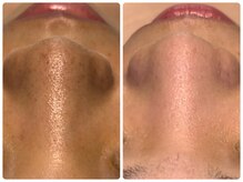 ベルドア(Bell Door)/ピーリング×ビタミン導入