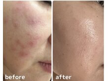 アンジェーム(angeame)/ニキビケア☆