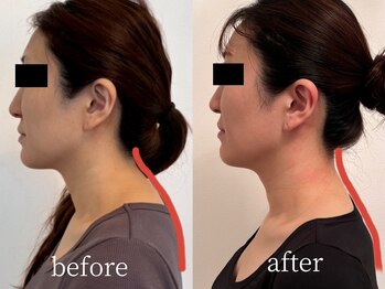 ベレミアム(Bellemium)/ストレートネック・スマホ首ケア