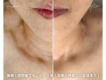 カシェボーテ(CACHE BEAUTE)の雰囲気（【シミシワケア/毛穴引締め/ニキビケア】プラズマフェイシャル）