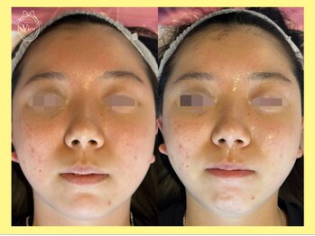 ハーブピーリング 名古屋/1回で小顔！脂肪分解美容液♪