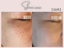 美シェリ(美Cheri)/シミケアビフォーアフター