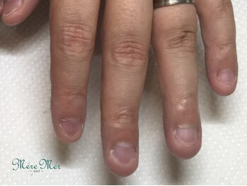 パラジェル認定サロン メールメール 池袋店(MereMer)/(開始) 115 深爪 深爪緩和 ケア