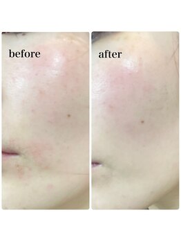 ラシック(Rachic)/クリスタルハーブパック☆