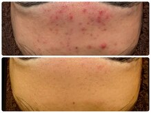 ハーブピーリング 恵比寿/ハーブピーリングbefore→after