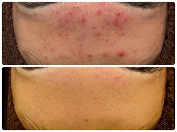 ハーブピーリング 恵比寿/ハーブピーリングbefore→after